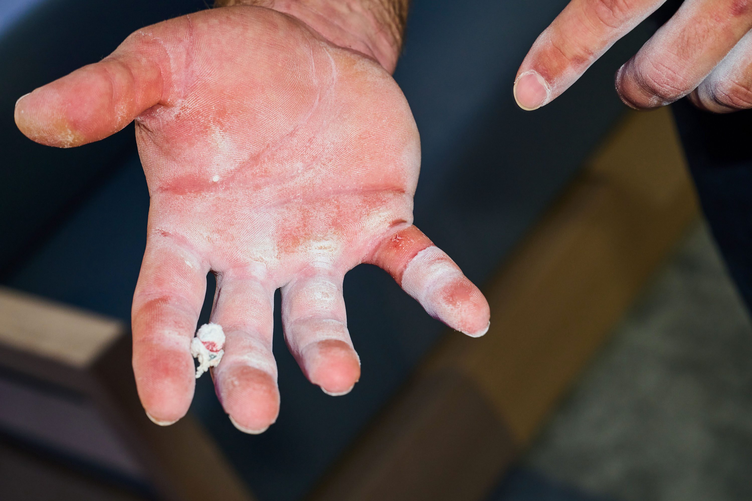close-up of the calloused and powdered hands of a weightlifter with remnants and marks left by the tape.